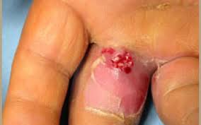 Image result for phlegmon on face)