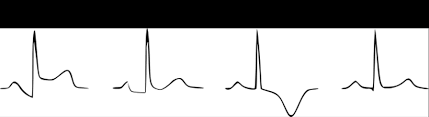 Das kann wegen eines unvollständigen schliessens der herzkammer sein. Ekg Bei Perikarditis Fokus Ekg