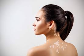 Image result for Vitiligo