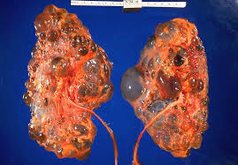 It may be caused by a variety of conditions. Nursing Interventions For Polycystic Kidney Diseasenursing File Nursing File