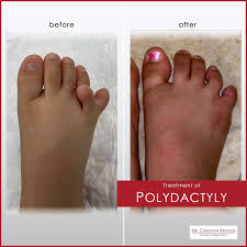 Image result for Polydactyly