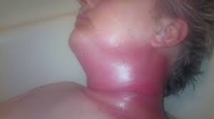 For example, throat cancer pictures below are three. Beating Hpv Positive Throat Cancer Huffpost