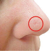Image result for skin cancer on nose pimple