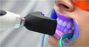 Philips zoom whitening gives you the confidence to do what you do best, shine. Zoom In Office Teeth Whitening Doral Fl Smiles At Doral