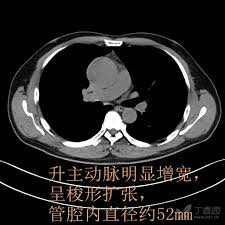 主動脈剝離（英語：aortic dissection；法語：dissection aortique；德語：aortendissektion），又譯為主動脈夾層或心血管動脈剝離，是因為主動脈血管內膜（英語：tunica for faster navigation, this iframe is preloading the wikiwand page for 主動脈剝離. ä¸»å¨èç¤ä¸ä¸»å¨èå¤¹å±çctè¡¨ç° ä¸ å½±åå»å­¦å'æ ¸å»å­¦è®¨è®ºç ä¸é¦å­è®ºå
