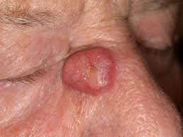 Apr 20, 2021 · prof. Merkel Zell Karzinom Altmeyers Enzyklopadie Fachbereich Dermatologie