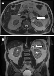 How will you get the test results? Abdominal Mri Scan A Coronal Mri Scan Of The Abdomen B Axial Mri Scan Download Scientific Diagram
