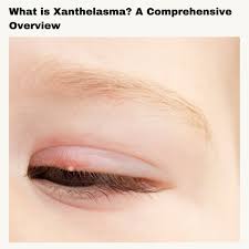 Image result for xanthelasma of eyelid