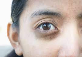 Tratamiento Ojeras En Valencia Dr Mira Elimina Ojeras Oscuras Y Hundidas