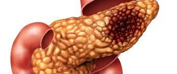 Treatment incorporates chemotherapy, radiation therapy, and/or surgery. Ø³Ø±Ø·Ø§Ù† Ø§Ù„Ø¨Ù†ÙƒØ±ÙŠØ§Ø³ Ø§Ù„Ø£Ø³Ø¨Ø§Ø¨ Ø§Ù„Ø£Ø¹Ø±Ø§Ø¶ ÙˆØ§Ù„Ø¹Ù„Ø§Ø¬ ÙˆÙŠØ¨ Ø·Ø¨