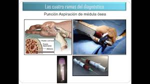 Leukemia is a type of blood cancer that affects your bone marrow, which makes blood. 2016 07 Leucemia Promielocitica Aguda Youtube