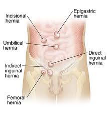 A cyst in my pelvis was found. What Is A Hernia Saint Luke S Health System