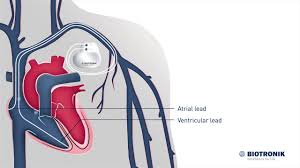 The pacemaker's pulse generator sends electrical impulses to the heart to help it pump properly. How Pacemakers Work Medical Animation Youtube