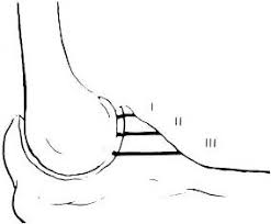 Image result for Coronoid Process Fracture