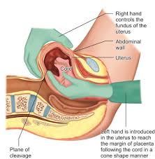 Sometimes the placenta gets stuck on the wall of the womb (retained placenta), and does not deliver and in these circumstances you would usually require a manual removal of the placenta under. Jaypeedigital Ebook Reader