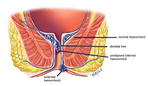 Image result for hemorrhoids