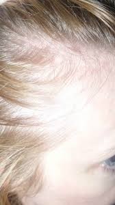 Generally, the more testosterone, the faster and coarser body and facial hair will grow. Uk Mum Solves Hair Loss Problem Issuewire