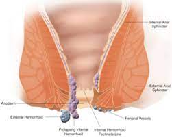 Complications of rubber band ligation of symptomatic internal hemorrhoids. What Are Hemorrhoids Gastroenterologists Richmond Va