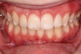 This Is A Picture Of White Spot Lesion Wsl Formation Mighty Brace Was Created In Part To Help Increase Motivational Techni Orthodontist Braces Off Dentistry