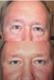 Eyelid Surgery