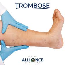 Hier lees je alle belangrijke informatie over deze vorm van trombose. Trombose Saiba Tudo Sobre A Doenca Centro Alliance