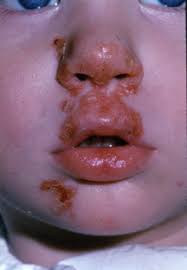 Image result for yellow scabs on the face in children