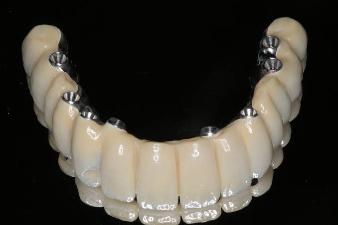 all on 4 all on 6 implant