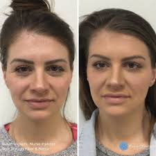 Susan Vickers, BSN, RN, CANS (@injectablesusan) · Franklin, TN