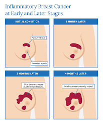 Image result for Breast Cancer