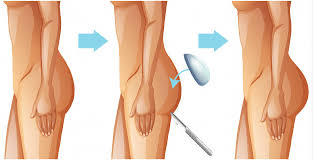 La liposuccion est l'intervention de chirurgie esthétique la plus pratiquée dans le monde. Augmentation Fesses Tunisie Prix Implant Fessier Tunisie