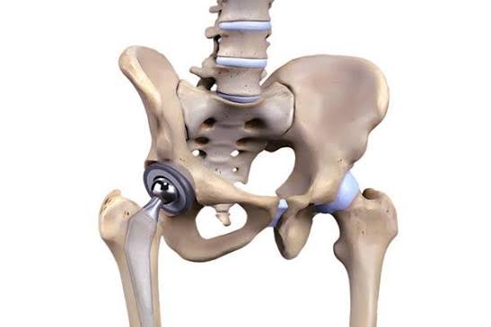 Hip Replacement Surgery product image