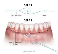 Do i really need to floss? Oral Hygiene For Fixed Bridgework Flossing Around Dental Implants