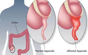 Complications may include shock and acute respiratory distress syndrome. Peritonite Archivi Dottor Antonio Giuliani