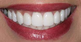 Aug 07, 2019 · a new procedure can correct a gummy smile without having to go under the knife. How To Fix Gummy Smile In Photoshop