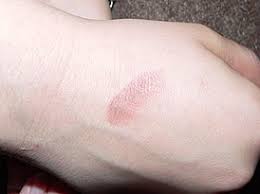 Заболевание, обусловленное развитием особой (чаще аллергического типа) реакции организма при инфекционных болезнях (ангине, скарлатине, бруцеллезе, туберкулезе, лепре. Eritema Vikipediya