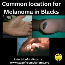 Image result for Acral lentiginous melanoma nail