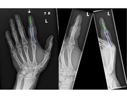 Image result for Interphalangeal Dislocation