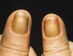 Image result for Akutní zánět nehtového lůžka