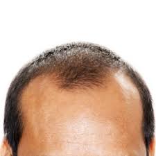 Hair loss treatment masks tend to be the most affordable option, ranging from $12 to $44. Can Caffeine Shampoo Cure Baldness Health24