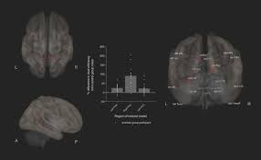 Doctors say those who find the camel will be far from here is the correct answer to find the camel in picture puzzle. Human Hippocampal Ca3 Damage Disrupts Both Recent And Remote Episodic Memories Elife