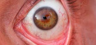 Dies ist eine krankheit, die viele virale konjunktivitis. Bindehautentzundung Konjunktivitis Ursachen Beschwerden Diagnose Behandlung Prognose Vorbeugung Gesundmed Medizin Und Gesundheit Im Web