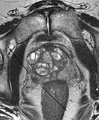 This hypointense line can be used to assess extraprostatic tumor growth. Prostate Cancer Detection Using 3t Mri At Radiology Associates Radiology Associates Of Ridgewoodradiology Associates Of Ridgewood