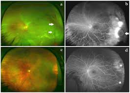 A giant retinal tear typically develops slightly posterior and parallel to the ora serrata, with the vitreous base attached to the anterior margin of the tear. Evaluation Of Rhegmatogenous Retinal Detachments Using Optos Ultrawide Field Fundus Fluorescein Angiography And Comparison With Etdrs 7 Field Overlay Sciencedirect