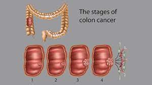 Signs of dying from cancer. Colon Cancer Stages What Do They Mean For Survival Everyday Health