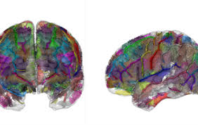 Other characteristics are atypical patterns of activities and behaviours, such as difficulty with transition from one activity to another, a focus on. English Portal Autism Spectrum Disorders A New Brain Imaging Study Appears To Challenge The Dominant Theoretical Model