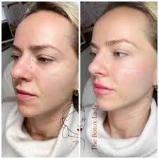 London/Lips/Fillers/Clinic (@the_botox_shop_london2) • Instagram photos and  videos