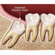 Read about tooth extraction near me pain costs and benefits. Wisdom Teeth Extraction Hollywood Smile Dental