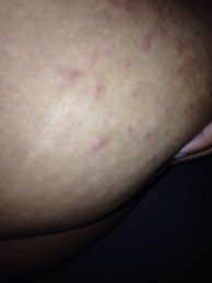 The disease is named because of its primary symptoms of redness and swelling. Breast Cancer Topic Should I Be Concerned With Ibc