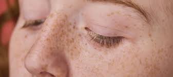 Image result for Freckled skin