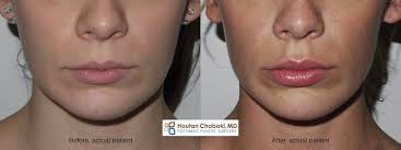 When the lips are injected, the upper lip tends to swell much more than the lower lip and often patients think that their upper lip has had too much filler injected into it. How To Reduce Swelling After Lip Injections And Botox